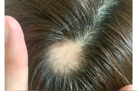 沈梦辰自曝“鬼剃头”，网友推荐涂生姜，专家：有用但不建议图片