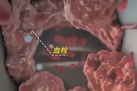 这种疾病听的不多，一旦发病后果却很严重！ ​