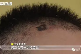头皮小小黑斑，竟然能致命！医生提醒：这些人要注意图片