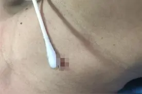 女子颈部长皮赘，轻信土方系红绳“结扎”险酿大祸图片