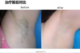 夏天就要来了，脱毛你需要知道的图片