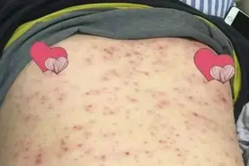 一旦感染终生携带，这种病毒太狡猾，还可能通过亲吻传播图片