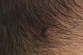 警惕！3岁男童后脑勺疼，结果发现一个“黑点”！严重可致命...图片