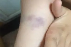 身上老有淤青咋回事图片