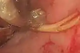 离奇！医生从男孩屁股钓出活龙虾，原因让人哭笑不得图片