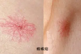 经常喝酒的人出现3个症状 当心肝脏病变图片