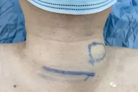 脖子突然增粗要小心，医生竟从他的脖子里取出一枚“血鸡蛋”图片