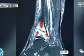 妈妈陪孩子练跳绳，小腿疼了两个多星期！到医院一查傻眼了图片