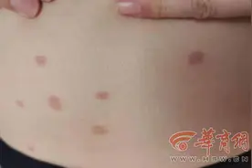 爱和邻居家猫咪玩还抱着睡觉 西安6岁女童全家得“癣”病图片