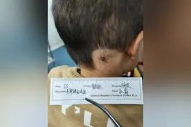 2岁小孩被蜱虫吸血多天，虫子涨大几十倍，取下来还活着图片