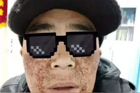 害怕！长沙40岁大叔一夜“毁容”，只因用了这款网红脱毛膏图片