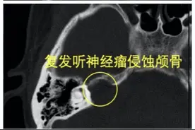 女子切除肿瘤后，9年“睁”眼睡觉，深圳医生给了她一个意外之喜图片