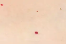 皮肤偶尔瘙痒、出现红点很多人不当回事，有可能是这些疾病的征兆图片