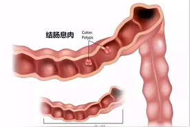 肠道内的“定时炸弹”：大肠息肉你不得不防图片