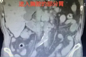 武汉48岁女子减肥催吐，谁知三分之一的胃跑进了胸腔图片