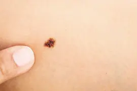 女子反复药水点痣“点出”恶性黑色素瘤图片