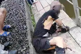 骇人！鱼钩甩上高压线，男子被电得头部漆黑、衣物熔毁……图片