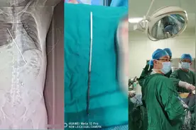 醉酒男子吞入20厘米烤肉钢签 穿透胸腔硬抗10天才就诊视频封面