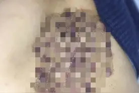 杭州大伯用这个办法治皮肤病，结果太吓人！医生提醒：别再这样了...图片