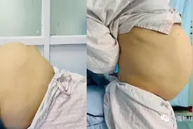 惊人！佛山45岁女子肚子变大，却并非怀孕图片