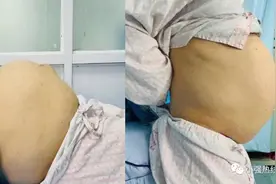惊人！佛山45岁女子肚子变大，却并非怀孕图片
