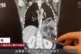 湖南10岁女孩剧烈咳嗽后持续腹痛，检查发现胃肠道竟移位到了胸腔内图片