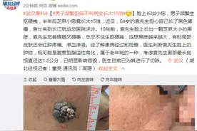男子频繁抠痣不料病变长大15倍，有时局部皮肤还会红肿疼痛、渗血渗液图片
