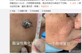 男子频繁抠痣不料病变长大15倍，有时局部皮肤还会红肿疼痛、渗血渗液图片