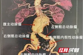 70岁爷爷腹藏5个“炸弹”泰和医院普外科专家成功拆弹图片