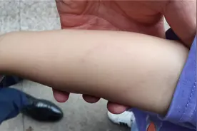 男童手臂被老师咬出牙印 托管中心：只为教育引导图片