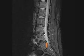 绿豆大的小东西，竟让人疼到坐卧不安图片