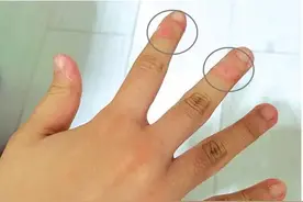 12岁了还啃，涂辣椒墨水都没用，很多孩子做这动作：手指都变形了图片