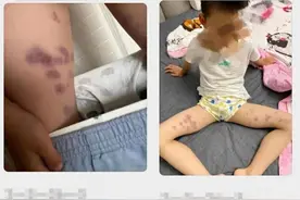 四川乐山一幼儿园多名幼儿被老师捏出淤青 涉事老师已停课，警方介入图片