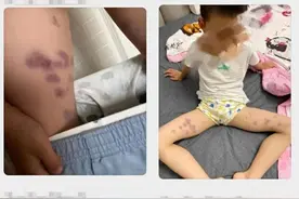 四川乐山一幼儿园多名幼儿被老师捏出淤青 涉事老师已停课，警方介入图片