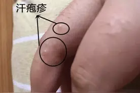 痒痒痒！一到夏天就长磨人的“小水泡”？这才是正确治疗方法图片
