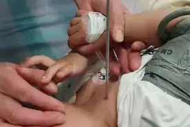 1岁婴儿颈部被毛线针穿透！幸好华西医院多学科专家联手，及时取出……图片