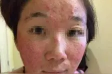 又红、又疼、又痒！折磨人的湿疹、荨麻疹，网传止痒方法靠谱不？图片