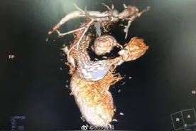 罕见！湘潭女子竟有4个脾脏 脾脏和胃肠还长反了……图片