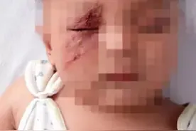 妈妈拍落隐翅虫3岁女儿险毁容图片