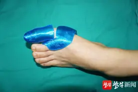 小伙大拇指断了，无锡九院医生给他“打印”了一个图片