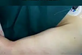 小伙左小指被海鲜刺破2毫米，出现感染性休克，左臂截肢保住性命图片