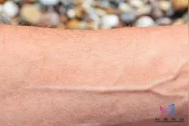 “青筋”暴起，说明有毒素淤积？尤其这几个地方，一定要注意图片