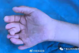 四岁女孩患“多指症”，手指脚趾总共27根图片