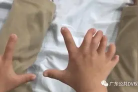 4岁女孩有27根手指脚趾图片