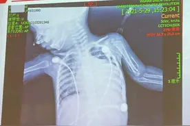 重获新生！9月大女婴在汉成功换“心”图片