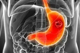 慢性胃炎该如何调养？饮食有限制、还需减轻压力图片
