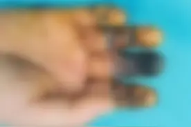 牛！一男子手指被压，医生用脚趾给他再造了一根......图片