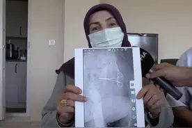土耳其61岁女子手术后疼痛异常，两个月后被告知肚中遗留一把剪刀图片