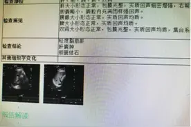 胆囊里取出300余枚结石，五莲县人民医院成功实施胆囊切除术图片