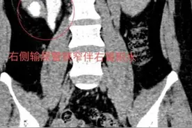 同济大学附属同济医院泌尿外科运用微创创新技术为一患者治疗输尿管多段狭窄图片